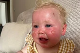 Mum's warning as baby suffers severe burns despite factor 50 sun cream