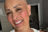 Melanie Sykes shares completely bald head after opening up about alopecia