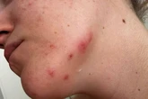 'I went to Butlin's for a friend's birthday and was surrounded by bugs'