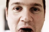 Dentist sheds light on condition turning tongues black and hairy