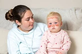 Baby suffers severe sunburn after just three hours outside with factor 50 on