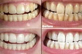 Shoppers say these 95p whitening strips make teeth look brighter