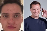 Man clears decade-long blemishes 'in four days' using grandma's recipe