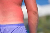 What happens after you get sunburned and the hidden effects of going red