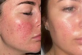 Teens praise 'life-changing' skincare products that leave them feeling 'more confident'