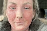 Birmingham woman says treatment left her 'looking like a burnt hamster'