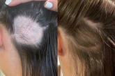 Amazon's £14 hair growth gummies hailed an 'absolute saviour' for hair loss and thinning
