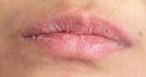 Dermatologist advises against two popular balms that can make dry lips worse