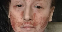 Woman who wouldn't leave house over eczema hails 'miracle' cream that helped skin