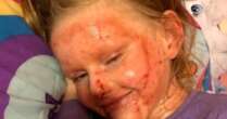 Daughter's 'endless battle' with horror eczema skin condition as mum issues warningVIDEOEczema