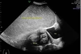 Pregnant woman complains of tummy pain before ultrasound scan unveils alarming find