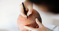Brit dies in Turkey after undergoing hair transplant as 'homicide' probe launched