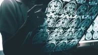 Nowe odkrycie w chorobie Alzheimera. „To może pomóc nam w odkrywaniu nowych leków”