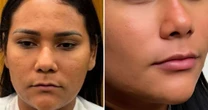 Ex-BBB Chaiany mostra resultado de harmonização facial e web avalia: 'Outra pessoa'