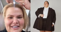 Influenciadora perde muito cabelo após cirurgia bariátrica: 'Se agravou no pré-cirúrgico'
