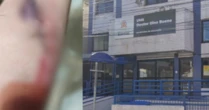 Pai presta queixa contra escola de Santos após filho com TEA cortar braço e levar 13 pontos