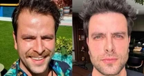Ex-BBB Gustavo faz harmonização, transplante e perde 8kg; veja transformação