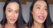 Gracyanne Barbosa mostra como ficou seu joelho depois de acidente no 'Dança dos Famosos'