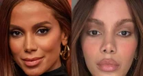 Lifting endoscópio e lifting labial: cirurgião plástico lista 4 indícios de que Anitta passou pelos 2 procedimentos estéticos