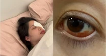 "Tive muito medo de ficar cega", disse influenciadora que sofreu hemorragia ocular após usar lentes vencidas