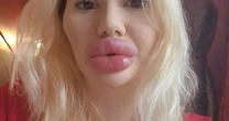Quem é Andrea Ivanova, mulher com maior lábio do mundo; ela diz que dentistas não querem atendê-la
