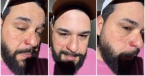 Sertanejo Léo mostra cicatrizes após ter rosto atingido por chamas durante show; veja