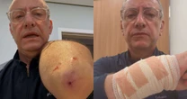 Veja o ferimento em âncora da Globo atacado por pitbull sem focinheira em SP