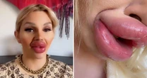 Influencer fica sem respirar após preenchimento labial e especialista alerta: 'Necrose'