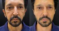 Ricardo Nunes realiza harmonização facial e fotos viralizam nas redes; veja antes e depois