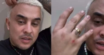 Matheus & Kauan: cantor mostra ferimentos após acidente