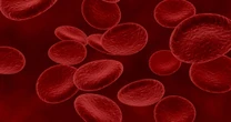 Mielodisplasia: doença silenciosa pode evoluir para leucemia