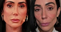 Preenchimento facial exagerado causa flacidez em Michelle Barros, explica especialista