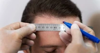 Queda capilar: médico explica quando considerar transplante
