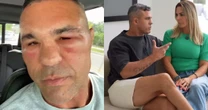 Vitor Belfort mostra rosto inchado após procedimento e faz comentário