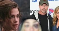 Estrela de '007', Denise Richards expõe fotos do rosto após ser espancada em episódio de paranóia do ex-marido: 'Me estrangulava'
