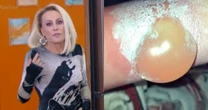 Ana Maria Braga assusta ao mostrar bolha causada em acidente doméstico: 'Ninguém tá livre'