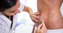 Lipo HD amplia possibilidades da definição corporal