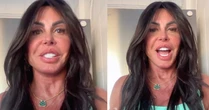 Gretchen surge com rosto redefinido após reversão da harmonização facial