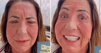 Mãe de Virginia surge irreconhecível após cirurgia nos olhos: 'Não está bonito'