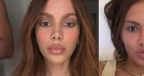 Exagerou? Após rosto 'irreconhecível' de Anitta viralizar, especialista alerta para riscos de procedimentos estéticos antes dos 35