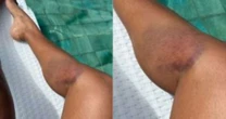 Sheron Menezzes sofre acidente e exibe hematomas após susto: 'Toda roxa'