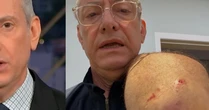 Âncora da Globo, José Roberto Burnier leva 4 pontos após ataque de pitbull sem guia: 'O preço da irresponsabilidade'
