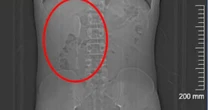 Homem bêbado engole colher de 15 centímetros e precisa passar por cirurgia no intestino