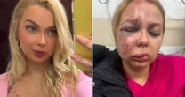 Jovem agredida no Metrô de SP teve joelho, maxilar e nariz quebrados: 'Ele queria que eu morresse'