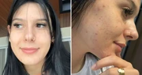Ana Castela revela uso de medicamento severo para acne e médica alerta: 'Não é qualquer caso'
