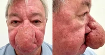 Escocês com nariz gigante se submete a cirurgia para reparar condição rara: 'Difícil beijar minha esposa'