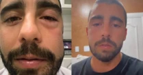 Pedro Scooby aparece com rosto inchado após procedimento e assusta seguidores; saiba motivo