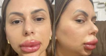 Confeiteira posta vídeo com inchado fora do comum após preenchimento e viraliza: 'Riram da minha cara'