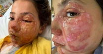 Menina de 10 anos sofre queimaduras graves no rosto após reproduzir desafio viral de rede social