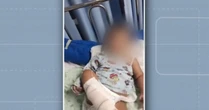Bebê é internado com bronquiolite e precisa amputar o pé; família acusa hospital de negligência